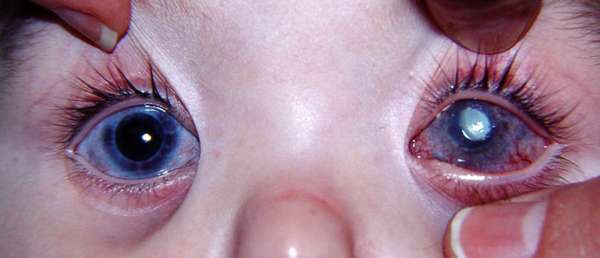 воспаление роговой оболочки глаза (кератит) у ребенка